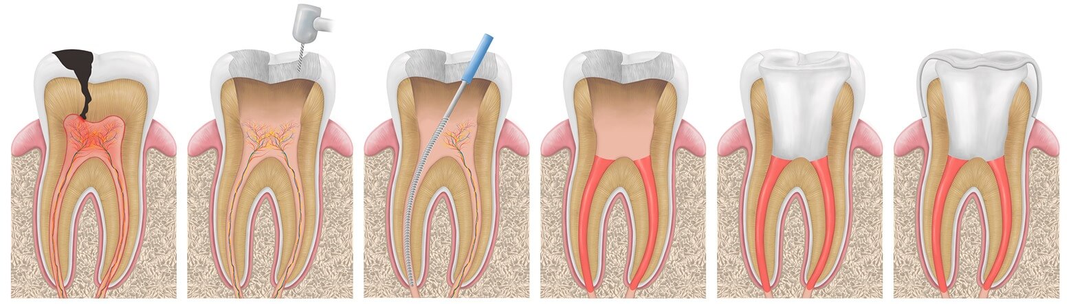 Root Canals